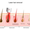 Understanding Hair Reduction Laser Treatment in Woodland Hills