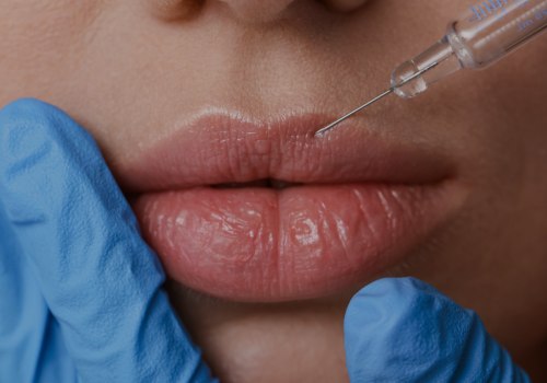 Enhance Your Facial Features with Lip Augmentation in Zurich