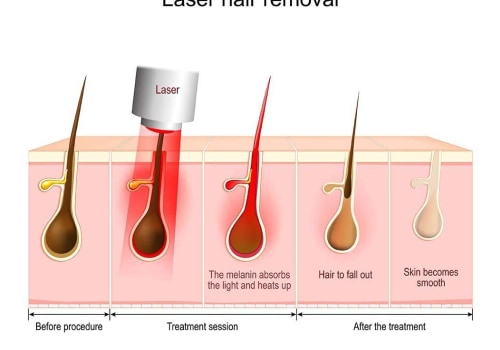 Understanding Hair Reduction Laser Treatment in Woodland Hills